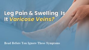Leg Pain and Swelling: Is It Varicose Veins?
