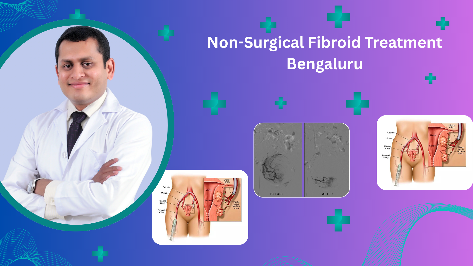Non-Surgical Fibroid Treatment Bengaluru Non-Surgical Fibroid Treatment Bengaluru