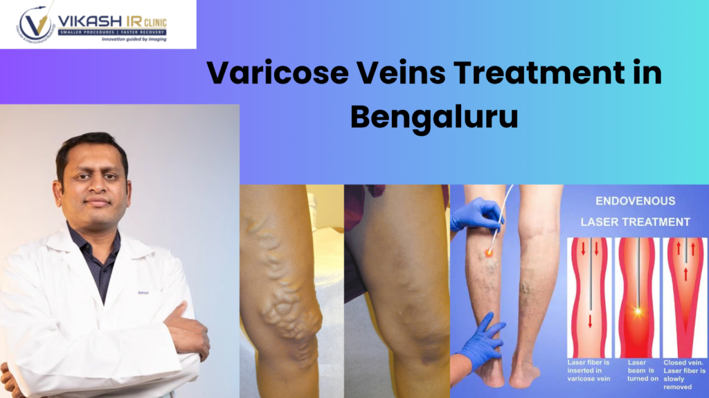 Best Varicose Veins Treatment in Bengaluru