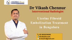 Uterine Fibroid Embolization Treatment in Bengaluru