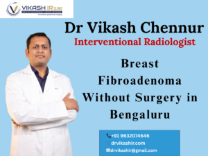 Breast Fibroadenoma Without Surgery in Bengaluru