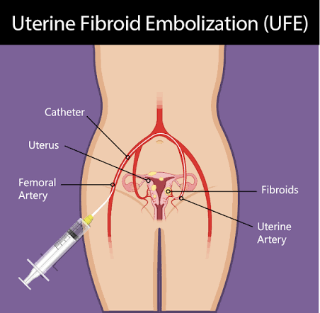 Do Fibroids Return After Uterine Fibroid Embolization (UFE)? images