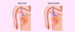 Common Symptoms of Varicocele